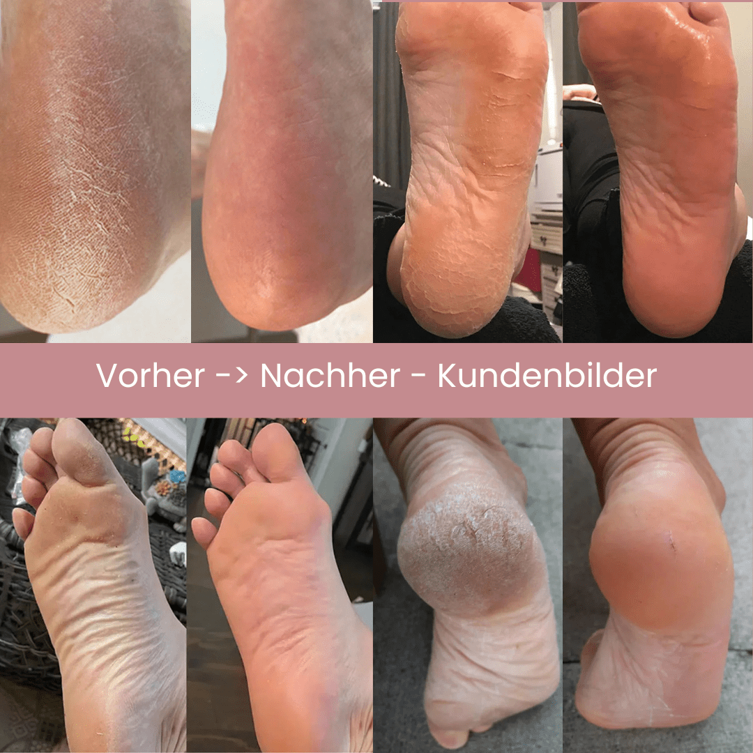 DermaGlide Pro inkl. 60 Glide Pads (Gratis) - DermaGlide