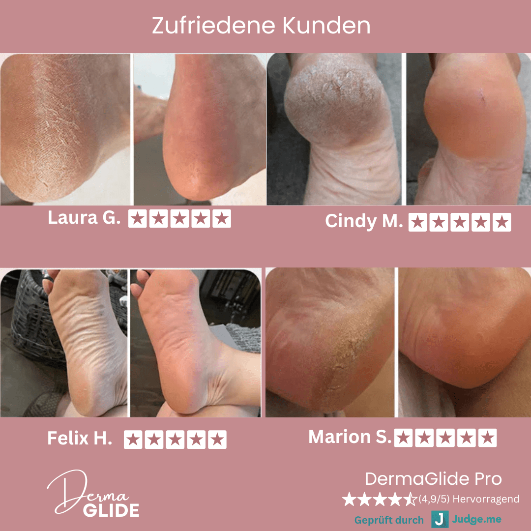 DermaGlide Pro inkl. 60 Glide Pads (Gratis) - DermaGlide