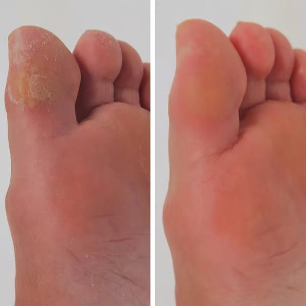 DermaGlide Pro inkl. 60 Glide Pads (Gratis)